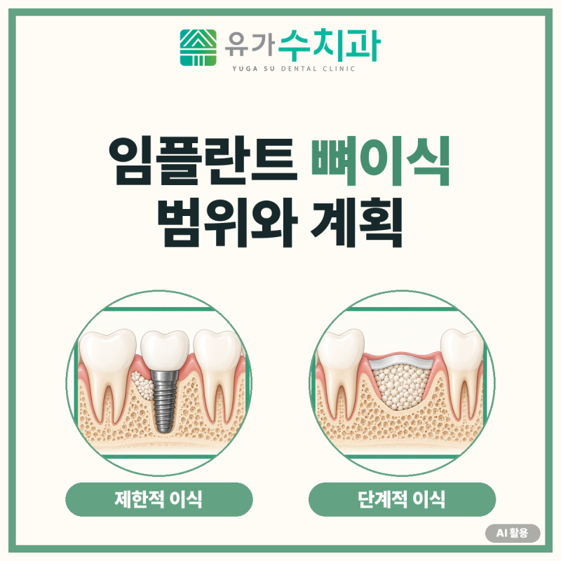 임플란트 뼈이식, 필요한 범위와 재료·치유기간은 어떻게 확인할까요?
