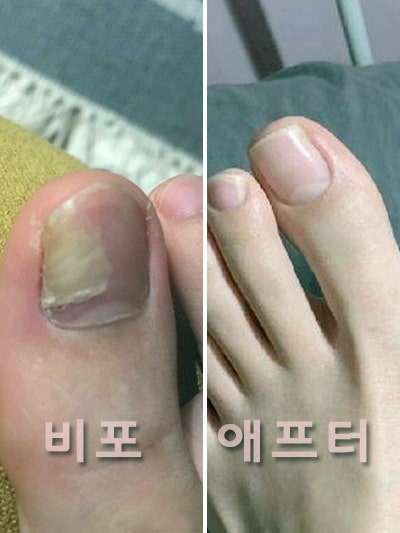 발톱 조갑박리증으로 고생하던 제가 단기간에 효과 본 홈케어 꿀팁