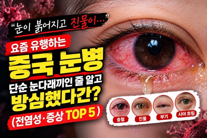 "눈이 붉어지고 진물이…" 요즘 유행하는 중국 눈병, 단순 눈다래끼인 줄 알고 방심했다간? (....