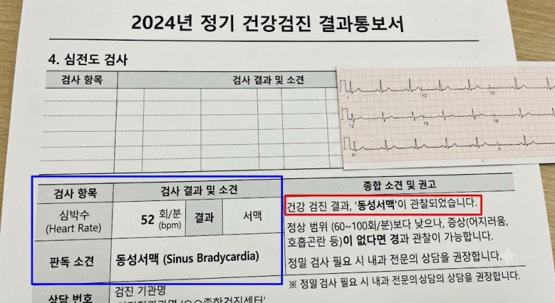 건강검진 결과지 분석! 동성서맥 판정을 받은 당신이 알아야 할 모든 것