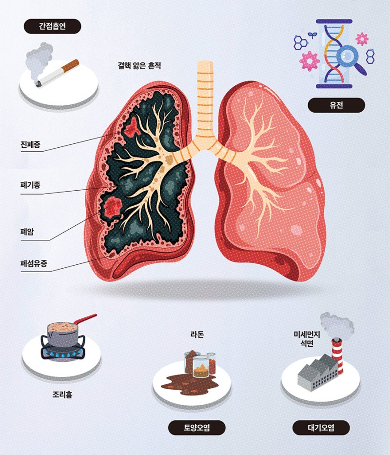 폐암