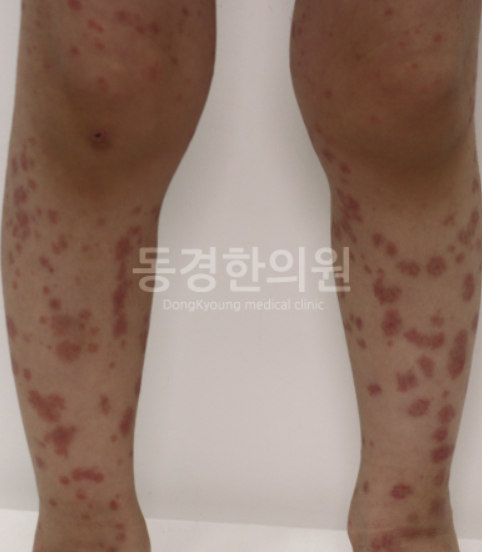 소아자반증, 아이 다리에 빨간 반점 올라왔을때 확인 사항