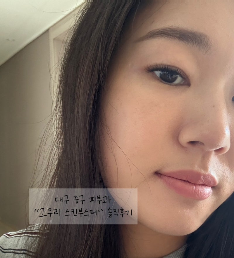 대구 고우리 스킨부스터 잘하는곳 중구 반월당 피부과 전후비교 솔직후기