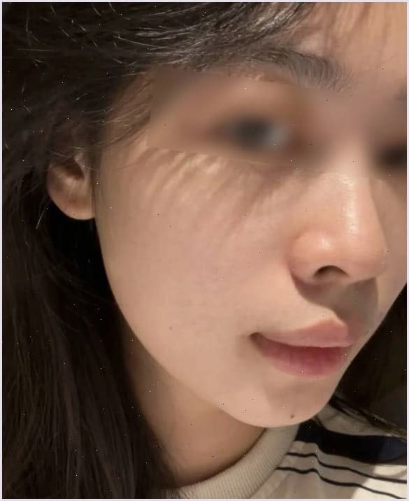 스킨보톡스 엠보 쓰고 50일 됐어요