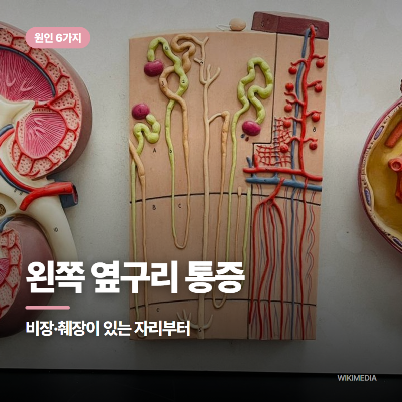 왼쪽 옆구리 통증 원인 6가지, 비장 췌장부터 :: 갈비뼈 아래 찌릿