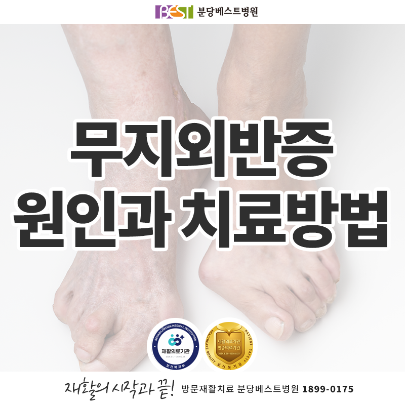 무지외반증, 엄지발가락이 휘어도 각도만으로 수술을 정하지 않습니다