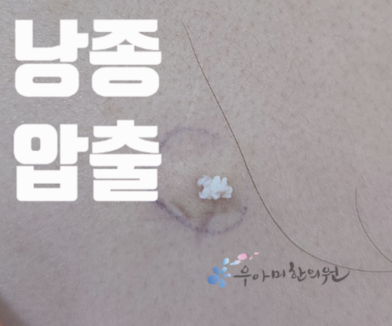 외음부 뾰루지 해부학 지도, 대음순 바깥쪽부터 질입구까지