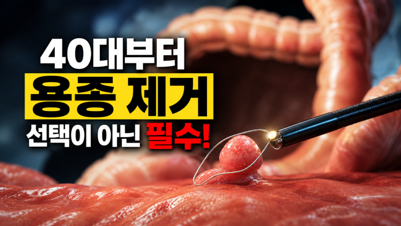 40대 이상 대장 내시경 용종 제거 건강 지키는 핵심 정보