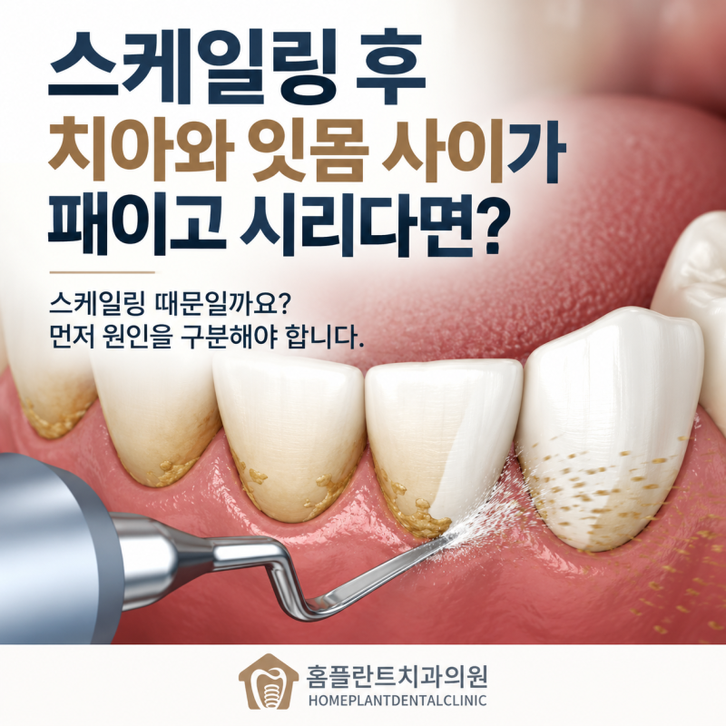 스케일링 후 치아와 잇몸 사이가 패인 것 같고 칫솔이 닿으면 시리다면?