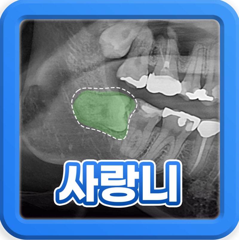 봉래동치과 사랑니 발치 후 통증, 운동 언제부터 가능?