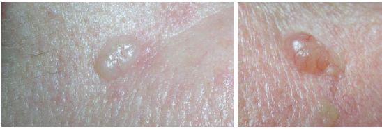 이런 게 피부암이라고? 흑자인 줄 알았는데…