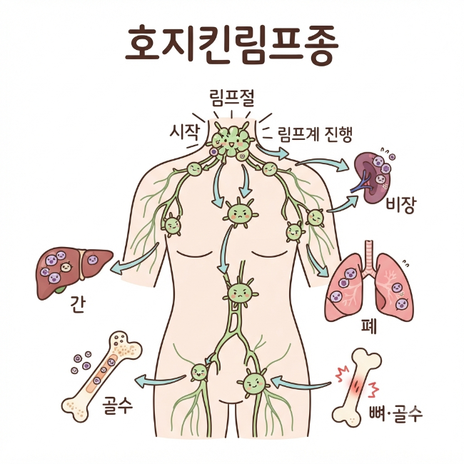 호지킨림프종 전이·진행 총정리｜림프절에서 주변 장기·골수 등으로 질환이 진행되는 과정