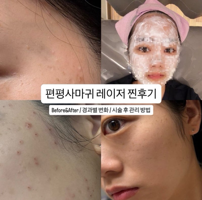 편평사마귀 제거, 편평사마귀 재생크림 추천, 천안아산 편평사마귀 제거 후기