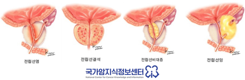 전립선암 수술 후 추적 관찰 기간·검사 비용 및 장애인 등록 세금 감면 혜택 총정리