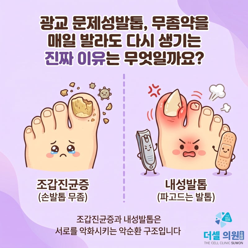 광교 문제성발톱, 약을 발라도 다시 생기는 진짜 이유