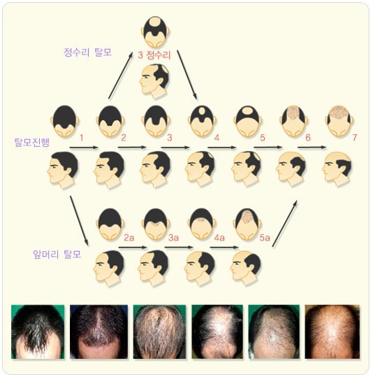 탈모 , 모발이식 ,,,