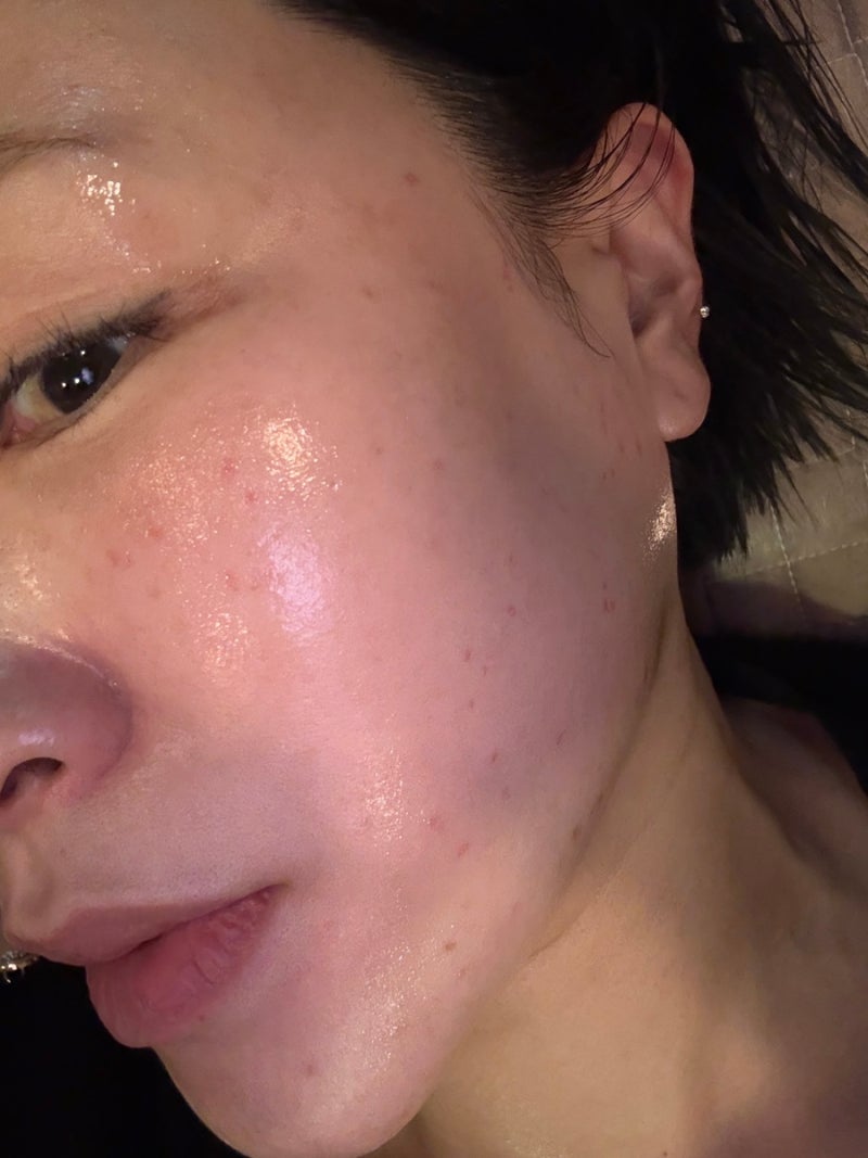 울산 편평사마귀 무제한 제거 리터치 성지