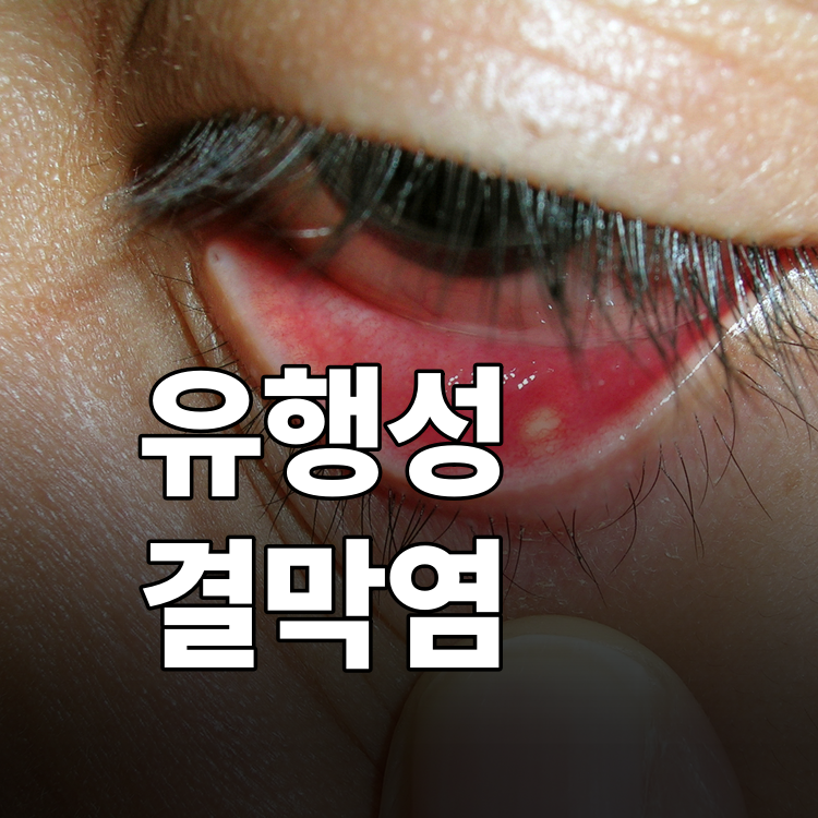 유행성 결막염 출근·등교 언제부터? 잘못된 민간요법까지