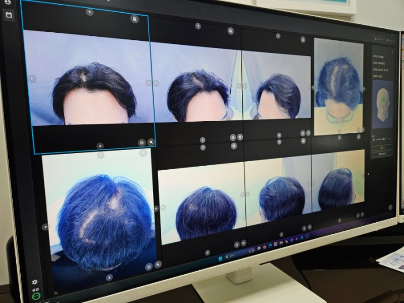 종로탈모병원 성지 유명한 이유? 5가 탈모약 처방받고 직접 치료 후기