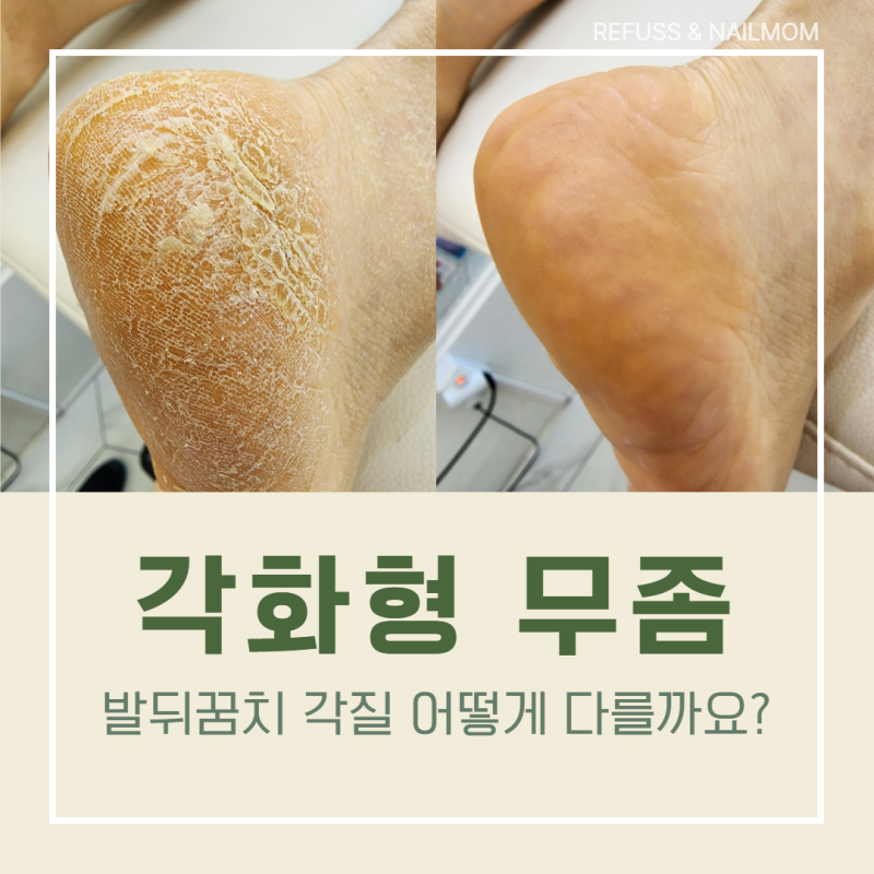 각화형 무좀 발뒤꿈치 각질과 어떻게 다를까요