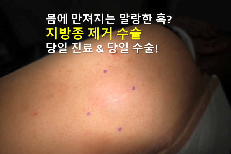 지방종 치료 및 제거 수술: 당일 진료·당일 수술 절차 한눈에 보기