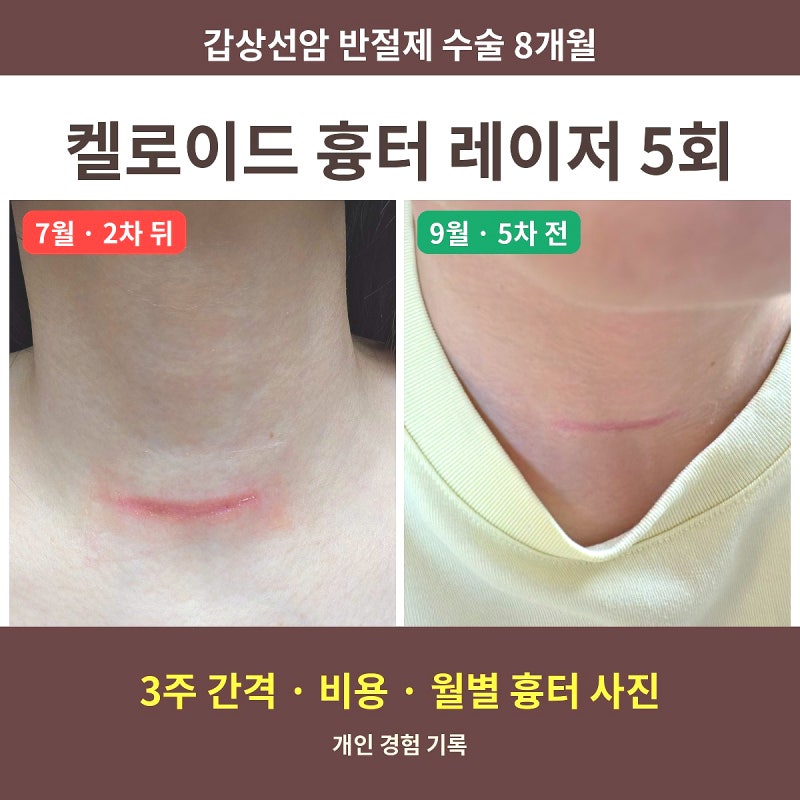 갑상선암 수술 후기 8개월 반절제 흉터 켈로이드 레이저치료 5회