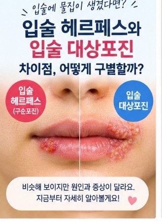 입술 헤르페스와 입술 대상포진 차이점