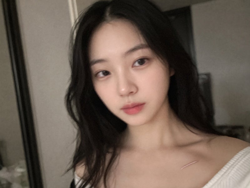 켈로이드흉터 치료 레이저 후기 통증 정도
