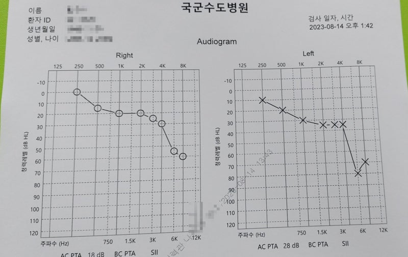 이명과의 싸움 / 카톨릭서울성모병원(박시내 교수) 등 치료 후기와 현재의 상태