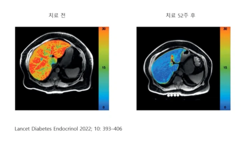 “몸무게만 봤다면 놓칠 뻔?” 마운자로 MRI 연구, 내장지방과 간 지방에 생긴 변화