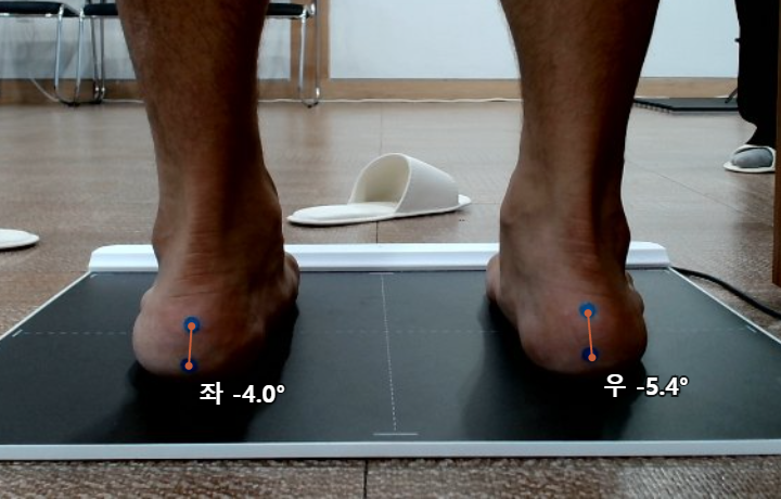 구두 뒤꿈치 통증, 한쪽 발만 아픈 이유를 확인한 맞춤 인솔 사례