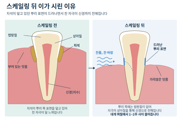 스케일링 안 시리게 받는 방법이 있나요? 치과에서 요청할 수 있는 것