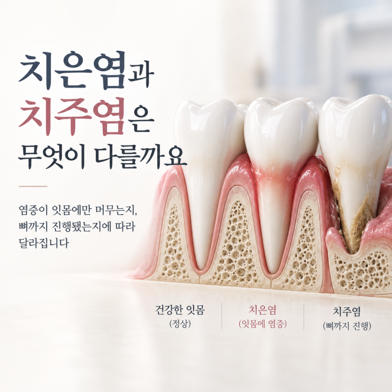 치주염 치은염과 무엇이 다른가요