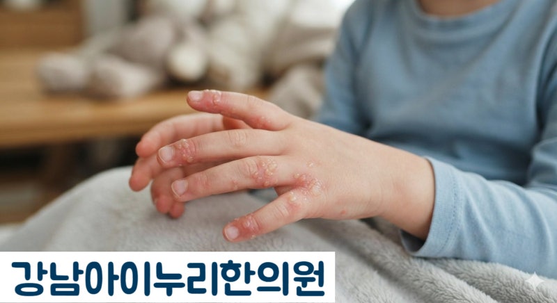 어린이 한포진, 손발에 생긴 물집과 가려움은 방치하면 안돼요!!