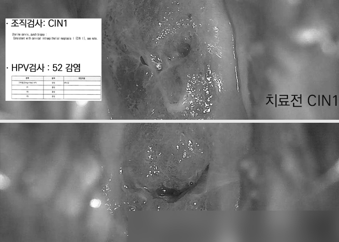 자궁경부이형성증 완치는 HPV 유형에 따라 다르다? (CIN1, CIN2, CIN3)