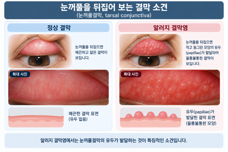 [호치민 김안과] 알러지(알레르기) 결막염, 왜 눈이 가렵고 어떻게 치료할까요?