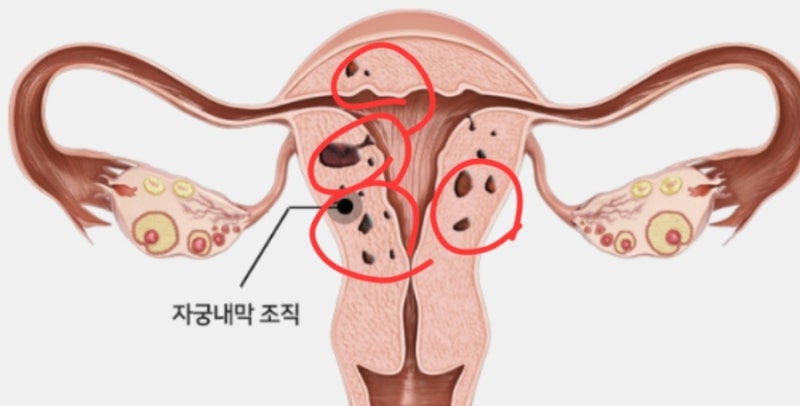 40대 초중반 미레나 시술 후기 및 부작용