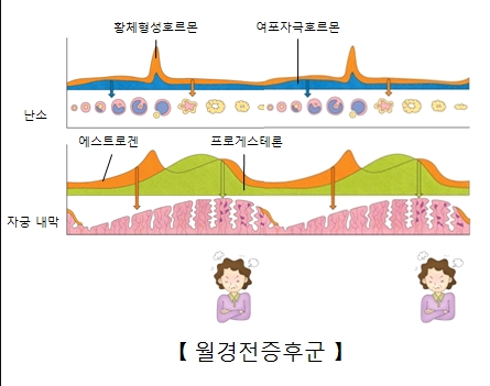 PMS증후군 증상 임신 극초기와 다를까? 가슴통증·아랫배 콕콕 차이