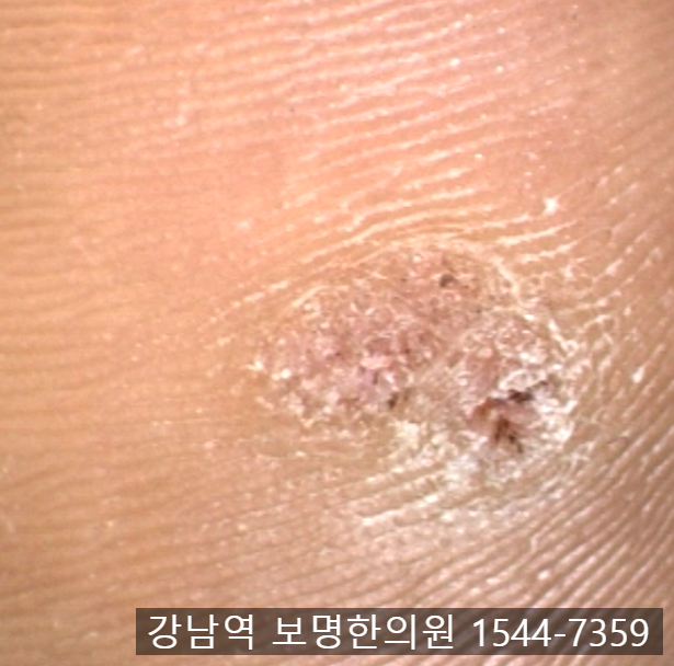 베루말액 사마귀 사용법과 주의사항 총 정리 (재발 관리 포함)
