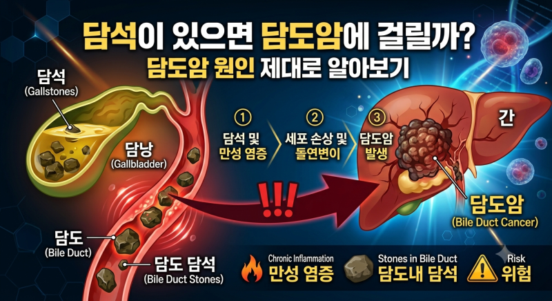 담석이 있으면 담도암에 걸릴까? 담도암 원인 제대로 알아보기