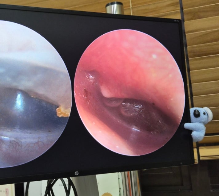 아기 중이염 증상 원인 항생제 치료 방법 주의사항