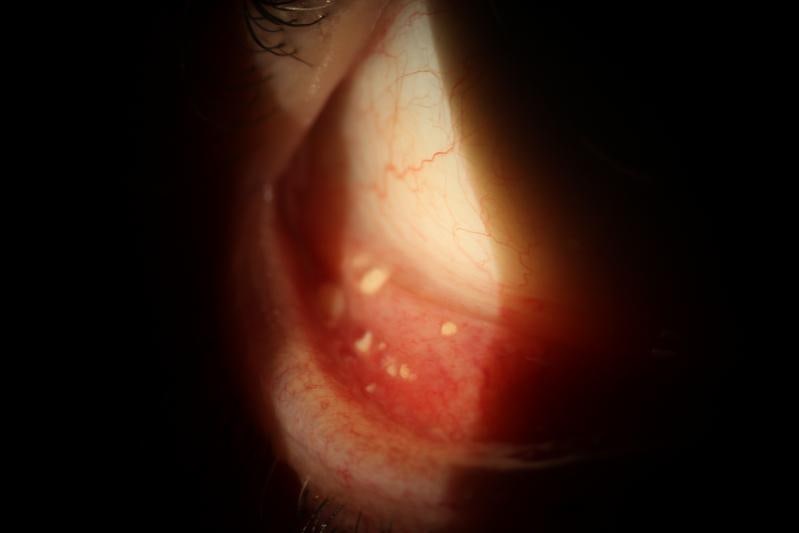 [호치민 김안과] 눈꺼풀 안쪽에 하얀 알갱이가? 결막결석(Conjunctival concretion)