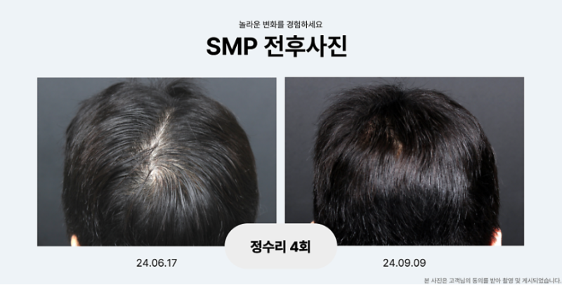 일산탈모병원, 가르마가 비어 보인다면 두피문신도 필요할까요?