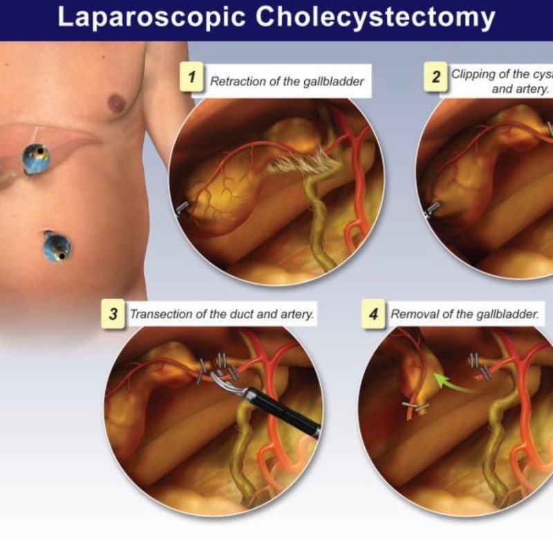 [간호사똥글]담낭절제술(Cholecystectomy)쉽게 알아보기_담석증,담낭염 수술과정+수술 후 간호