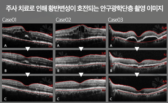 일산 행신동안과 황반변성 주사치료 종류부터 비용 변화까지