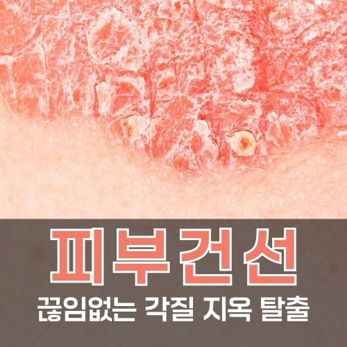 건선 원인과 치료, 피부건선 증상부터 관리법까지 정리