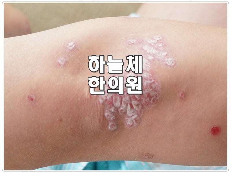 창원건선, 왜 생기고 없어졌다 다시 나타날까요?