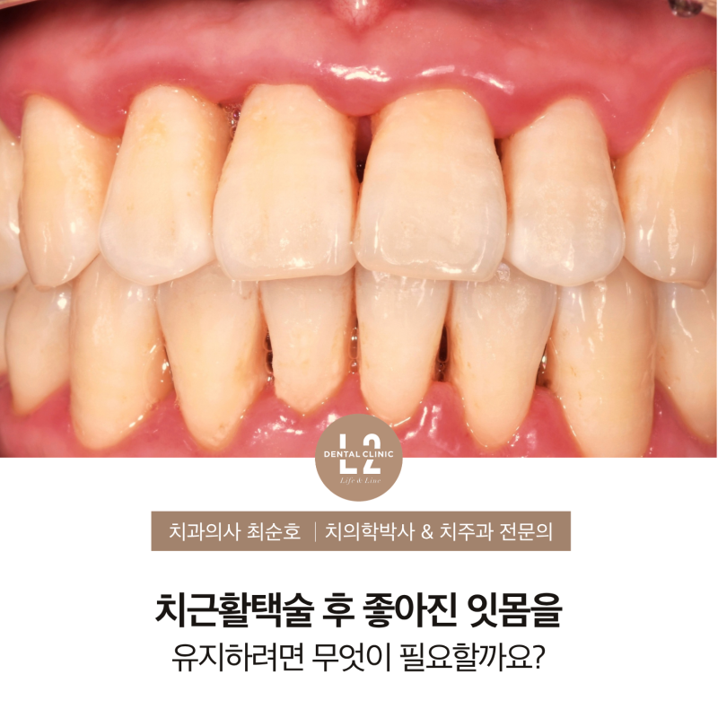 치근활택술 후 좋아진 잇몸을 유지하려면 무엇이 필요할까요?