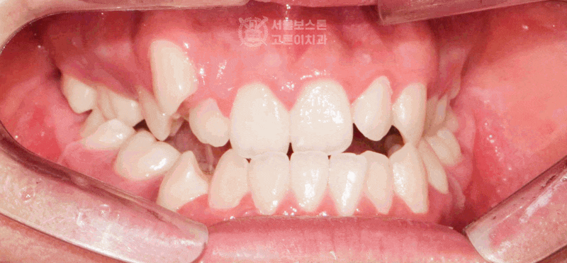정왕역 치과 의학 정보 | 주걱턱 & 덧니(크라우딩), 구강 내 부정교합이 문제가 될 수 있습니....
