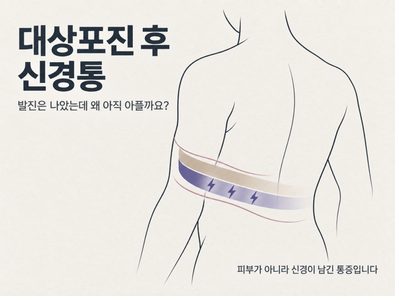 서현역 대상포진 후 신경통 : 발진은 나았는데 왜 아직 아플까요?